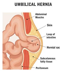 remedies for hernia