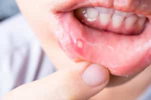 what are canker sores