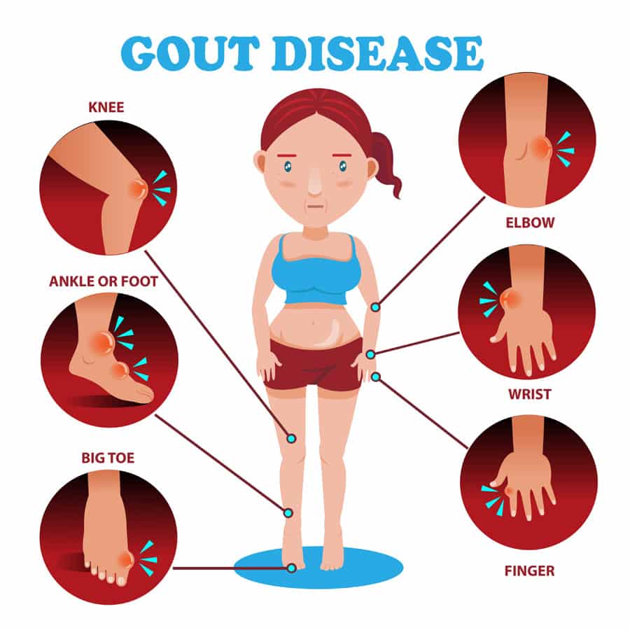 how to treat gout naturally