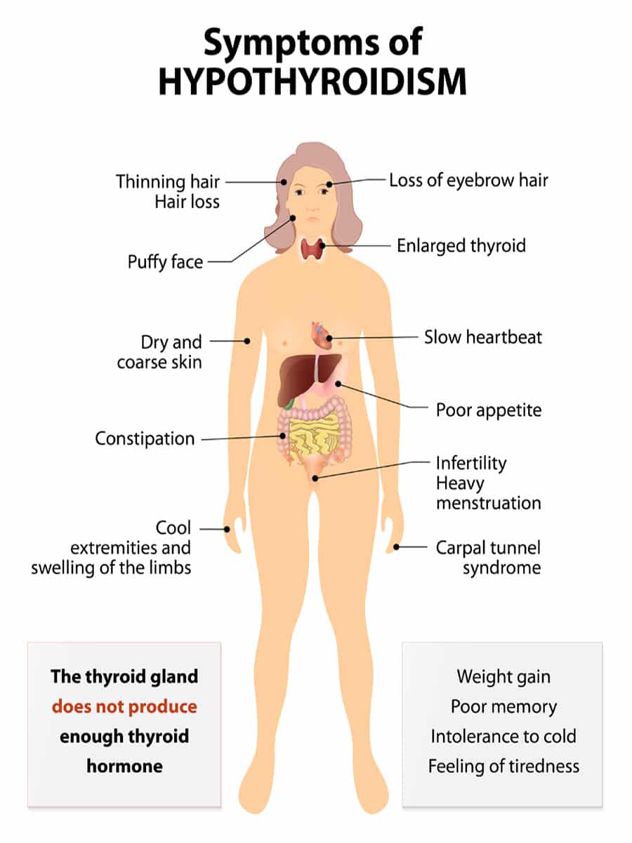 hypothyroidism symptoms