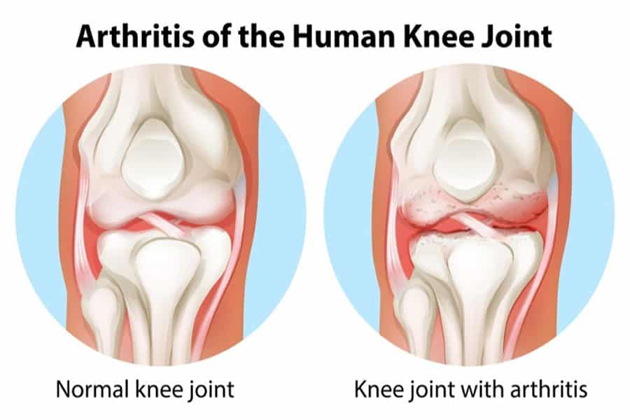 home remedies for rheumatoid arthritis