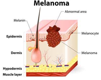 what-is-melanoma