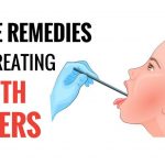 Home Remedies For Mouth Ulcers