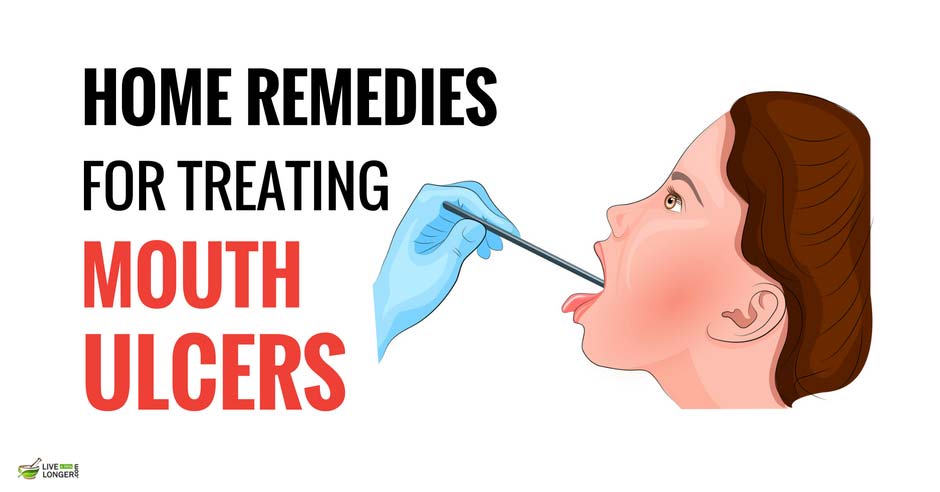 Home Remedies For Mouth Ulcers 