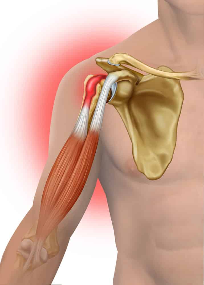 Common Workout Injuries