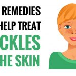 home remedy for freckles on face