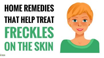 home remedy for freckles on face