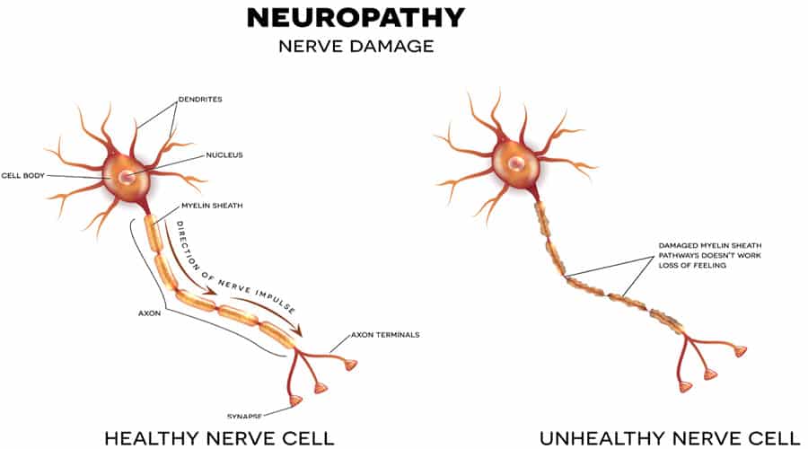 treatment for nerve pain