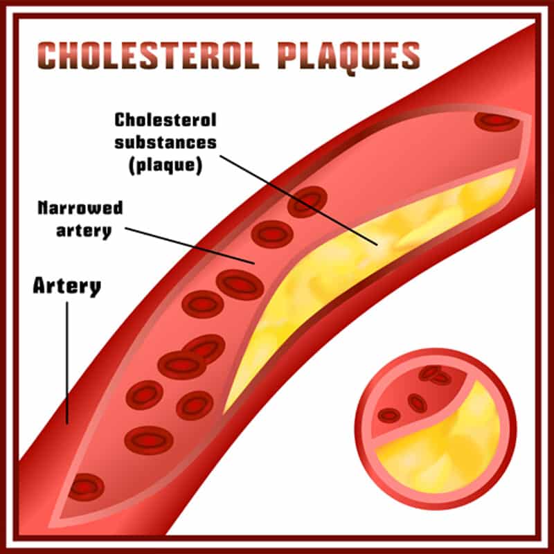 remedies for high cholesterol