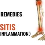 Best remedies For Bursitis