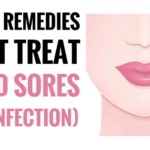 best Home Remedies For Cold Sores