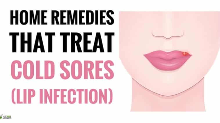 best Home Remedies For Cold Sores