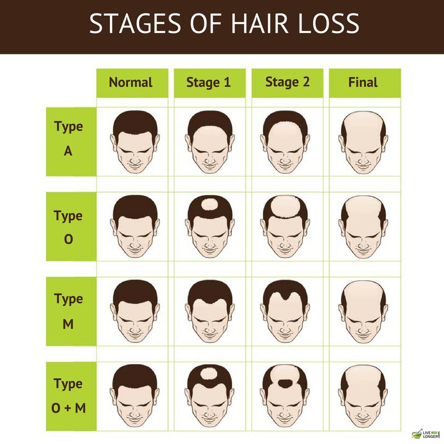 10 Clinically Proven Male Pattern Baldness Treatments To Stop Hair within How To Stop Hair Loss In Men pertaining to The house 10 Clinically Proven Male Pattern Baldness Treatments To Stop Hair within How To Stop Hair Loss In Men pertaining to The house