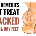 home remedies for dry feet and cracked heels