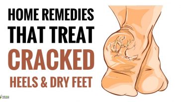 home remedies for dry feet and cracked heels
