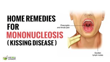 home remedies for Mononucleosis