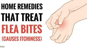 best home remedies for flea bites