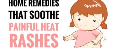 herbal remedies for heat rash