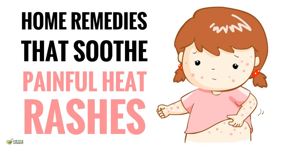 Best Natural Remedies For Heat Rash Best Natural Remedies For Heat Rash