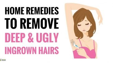 home remedies for ingrown hair bumps