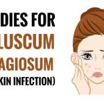 natural home remedies for molluscum contagiosum