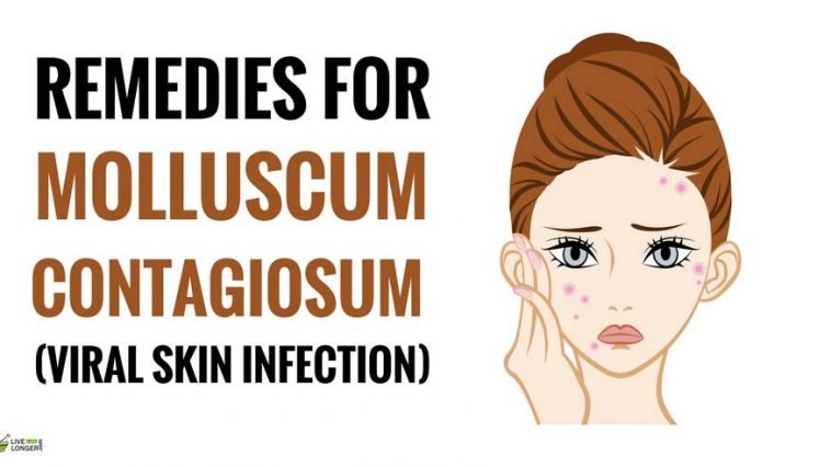 natural home remedies for molluscum contagiosum