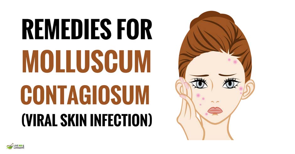 10 Home Remedies For Molluscum Contagiosum Skin Infection