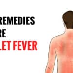 scarlet fever rash treatment