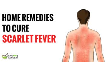 scarlet fever rash treatment