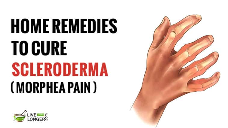 home remedies for Scleroderma
