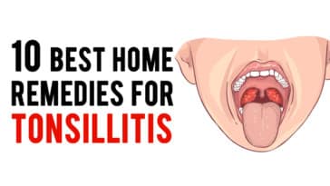 best home remedies for Tonsillitis