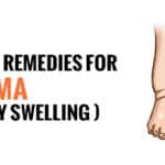 natural home remedies for Edema
