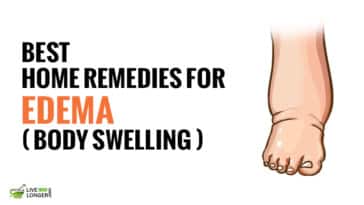 natural home remedies for Edema