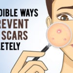 how to prevent acne